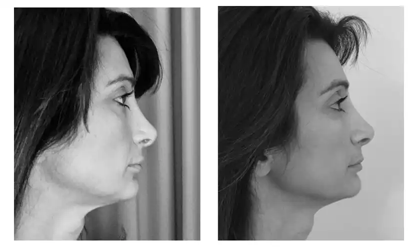 face-yoga-before-after-1