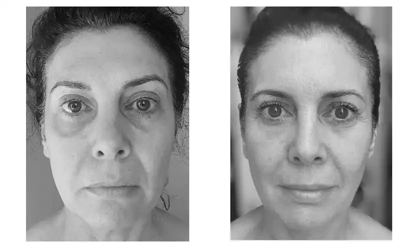 face-yoga-before-after-3