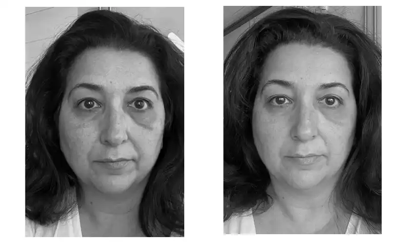 face-yoga-before-after-4