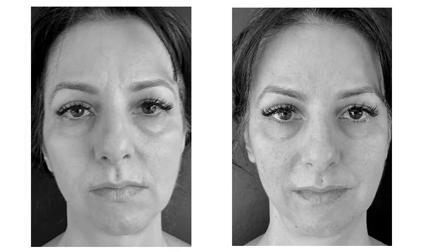 face-yoga-before-after-6