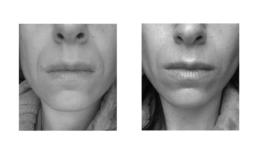 face-yoga-before-after-7