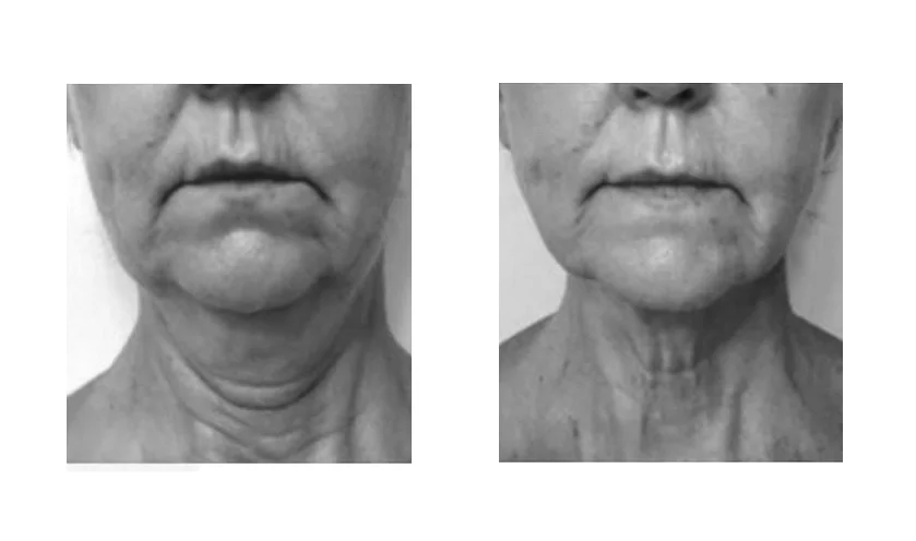 face-yoga-before-after-8